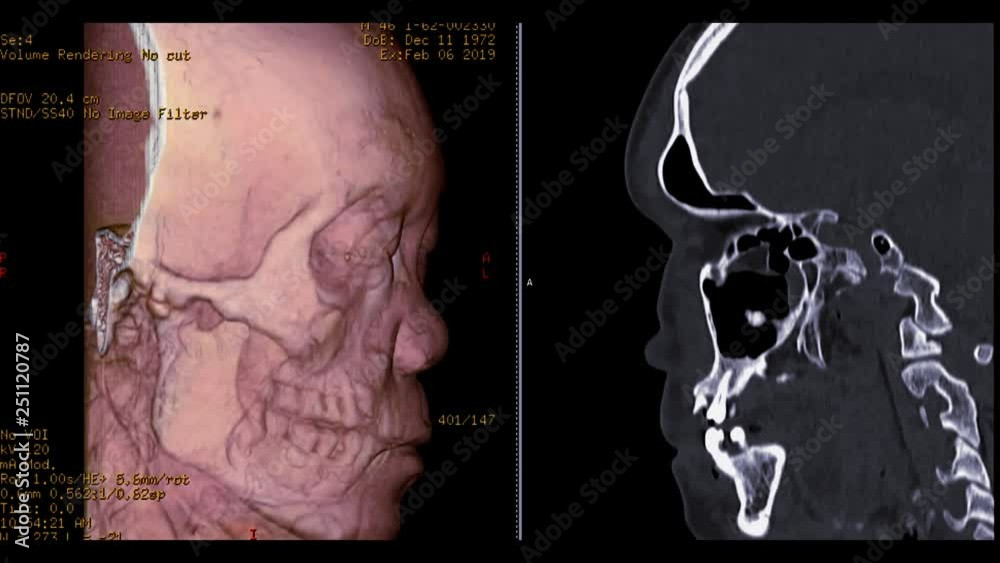 Poster ct scan of facial bone 3d rendering image from case head injury comparison 3d image vs sagittal imag