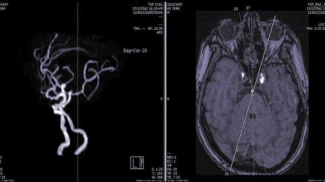 MRA brain or Magnetic resonance Angiography of the brain with contrast media 3D rendering image  vs 2D axial view showing vessel in the brain.