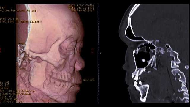 CT scan of facial bone 3D rendering image  from case head injury comparison 3D image vs sagittal image . realistic face .
