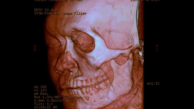 CT scan of facial bone 3D rendering image from case head injury. realistic face .