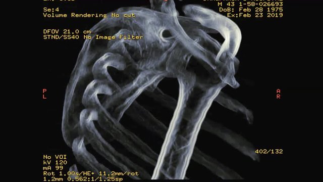 CT of Rt shoulder showing Fracture scapula bone 3d rendering image with transparency technique . realistic bone.
