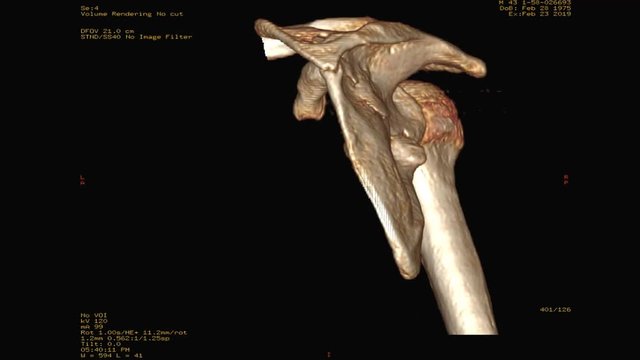 CT of Rt shoulder showing Fracture scapula bone 3d rendering image.