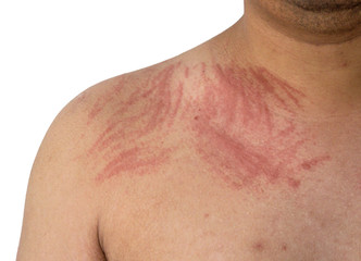 Allergy dermatographia on skin