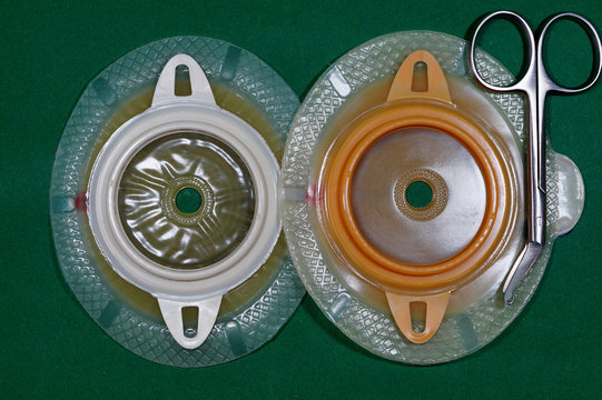 Urostomy - Ostomy medical care equipmen: Two-piece urostomy bag with the valve adhered to the skin of the patient. Ostomy plate for fixing urostomy bag