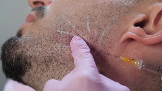 cosmetic injections for men