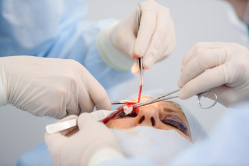 Blepharoplasty, plastic surgery operation for correcting defects, deformities, and disfigurations...