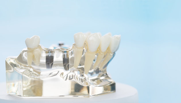 implant and orthodontic model for student to learning teaching model showing teeth.