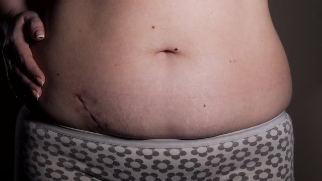 Woman showing the stomach with a appendicitis scar after surgery. Scar removal