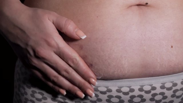 Woman showing the stomach with a appendicitis scar after surgery. Scar removal