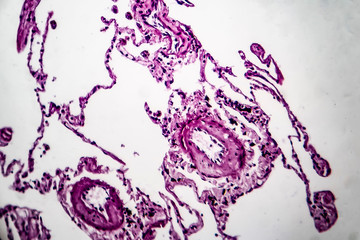 Histopathology of lung emphysema, light micrograph, photo under microscope showing enlargement of...