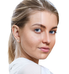 Young woman before and after skin treatment and makeup.