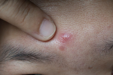 Fototapeta premium Hormone, The scars, wrinkle and acne inflammation on the face skin