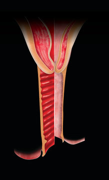 Atrophic vaginitis is inflammation of the vagina as a result of tissue thinning due to not enough estrogen. After menopause the vaginal epithelium changes and becomes a few layers thick. Genitourinary