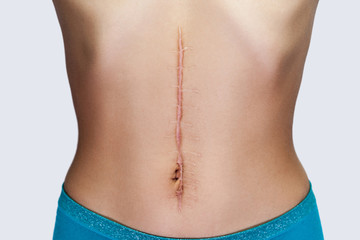 Closeup of young woman with large scar after surgery on abdomen. medical treatment and scars removal concept. indoor studio shot, isolated on grey background. - obrazy, fototapety, plakaty