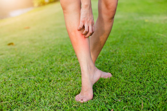 Women with his feet, itching on the lawn caused by insect bites and stings/health and medical view and devising concepts.