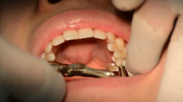 4K Close up of mouth and fillings and crowns on teeth with amalgam