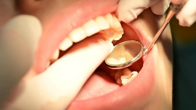 4K Close up of woman mouth before fillings teeth