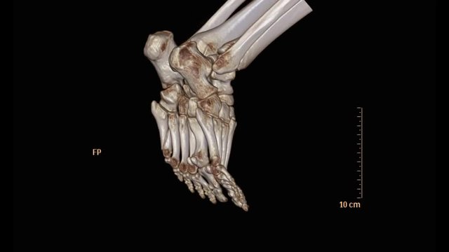 CT Scan of both foot  3D rendering image rotating on the screen.
