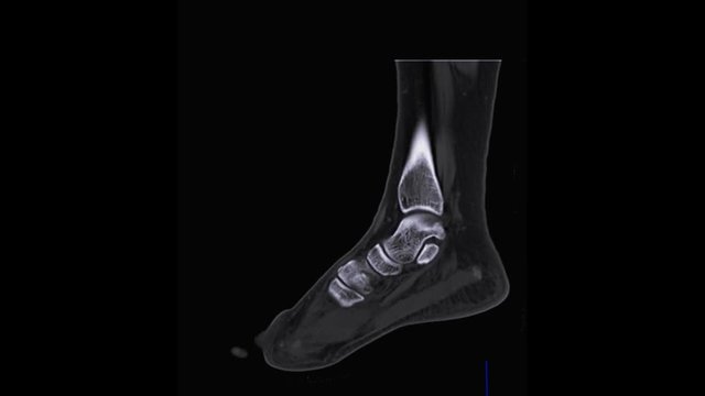 CT Scan imaging of right foot sagittal plane .medical technology concept.