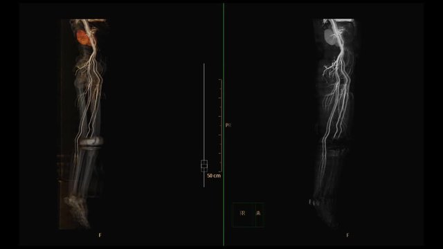 CTA femoral artery run off 3D rendering image vs MIP imaging showing  all vessel of lower Extremity . CT angiography of femoral artery.