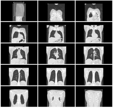ct scan step set of body lung coronal view