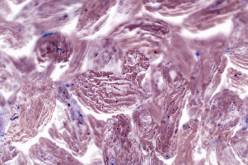 Human squamous cell carcinoma. Tissues affected by cancer cells under a microscope