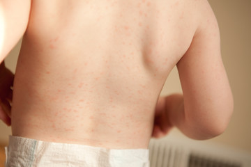 Little Girl with Skin Rash from Allergic Reaction to Amoxicillin - Health, Medicine, Skincare
