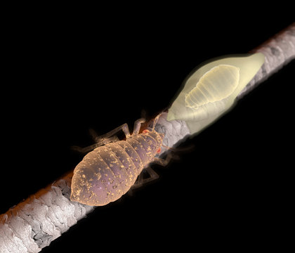 Lice on hair close up as a medical problem concept as follicles with an infestation of parasitic nits or eggs hatching from a louse insect as a symbol of infection with 3D illustration