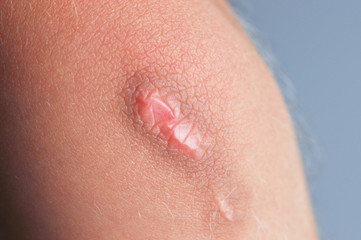 Scar on the skin.