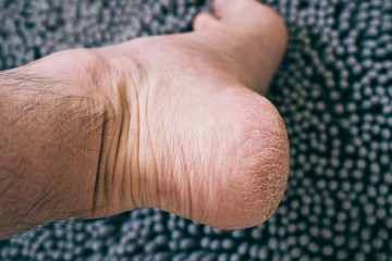 Obraz premium Dry and cracked skin on the heel of a Caucasian man