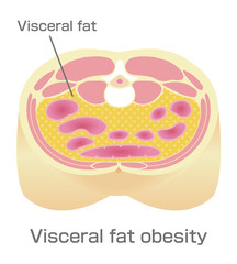 Type of obesity illustration . Abdominal sectional View (visceral fat ). 