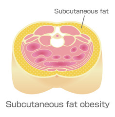 Type of obesity illustration . Abdominal sectional View (subcutaneous fat). 