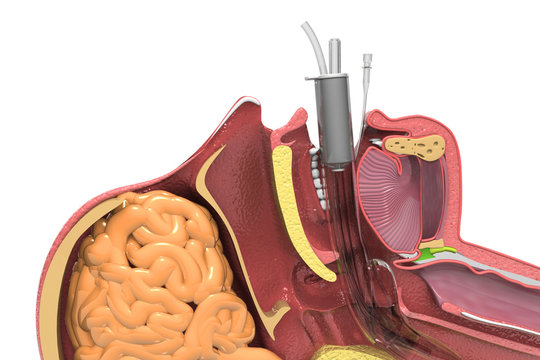 Endotracheal Intubation. Human head cross section. 3d render