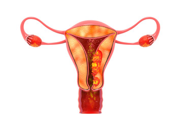 uterine cancer 3d render