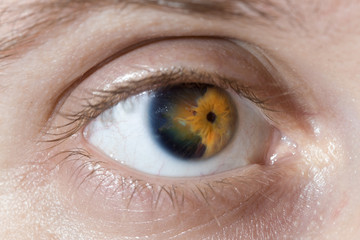 eye close up with iris dystrophy