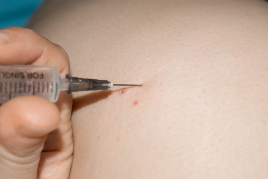 prick intramuscular injection with an antibiotic syringe into the buttock of a person for medicine