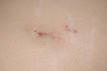 Fototapeta premium Traces of a shot in the ass blood blood wound cotton swab for medicine design