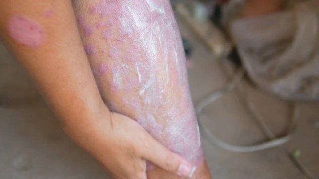 Psoriasis patients use herbal medicine to treat the wound on the right leg