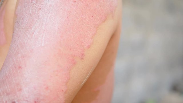 Psoriasis patients use herbal medicines to treat wounds in the arms