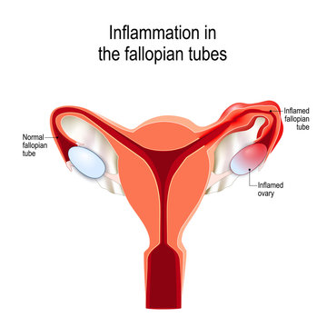 fallopian tubes Inflammation