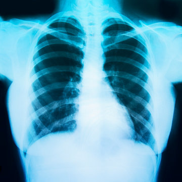  Chest x ray film of a patient