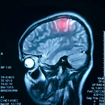 MRI of the brain, research, diagnosis and treatment of brain problems