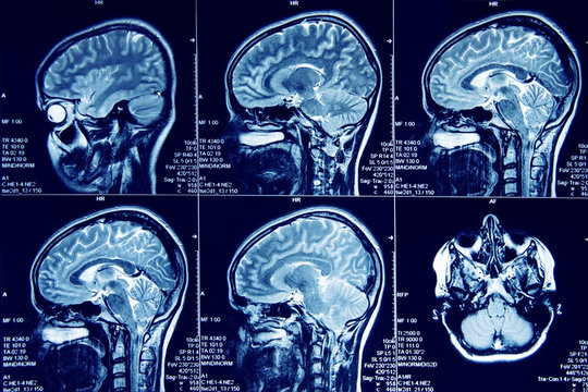Photograph of magnetic resonance imaging of human brain in sagittal plane. The study use for diagnosis brain tumor  or vertigo 
