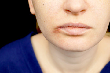Herpes on the lips: a woman with a cold and the herpes virus is examined by a dermatologist and...