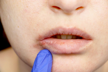 Herpes on the lips: a woman with a cold and the herpes virus is examined by a dermatologist and infectious disease specialist