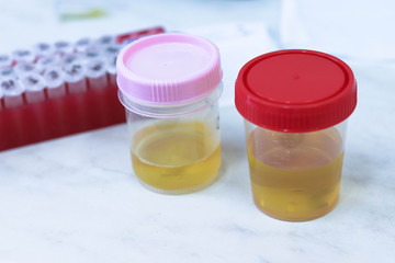 Urine samples in special tubes for examination. On the background of tubes with blood samples in the clinical laboratory