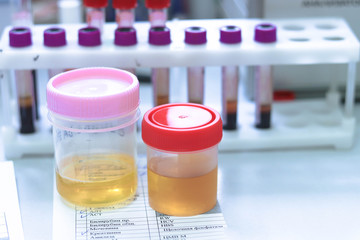 Urine samples in special tubes for examination. On the background of tubes with blood samples in the clinical laboratory