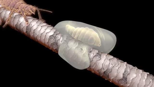 Lice on hair close up as a medical problem concept as follicles with an infestation of parasitic nits or eggs