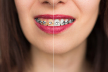 Teeth brackets whitening before after. Woman Teeth brackets  Before and After Whitening. Happy smiling woman brackets  face close up. Dental health Concept. Oral Care concept