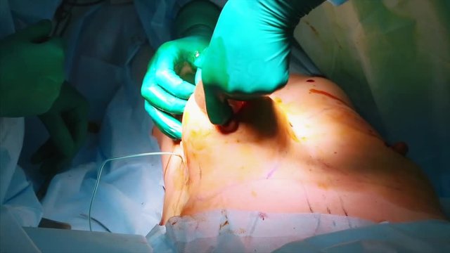 The introduction of the implant into the patient's chest during plastic surgery breast augmentation. The surgeon inserts under the skin a silicone implant of the female breast. Increases tits.